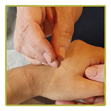 Akupunktur