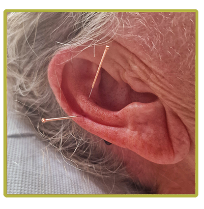Øreakupunktur