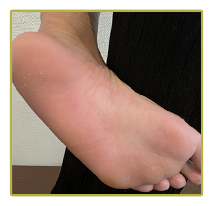 Behandling af hælspore